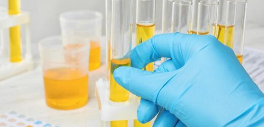 WHAT THE COLOUR OF YOUR URINE SAYS ABOUT YOUR HEALTH