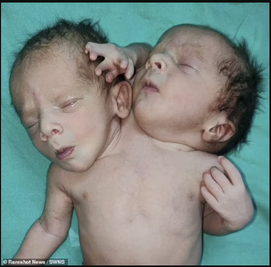 BABY IS BORN WITH TWO HEADS, THREE ARMS AND TWO HEARTS (PHOTOS)