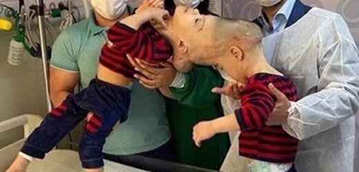 CONJOINED TWINS WITH FUSED BRAINS SEPARATED BY SURGEONS IN BRAZIL (PHOTOS)