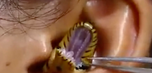 SURGEONS STRUGGLE TO REMOVE LIVE SNAKE FROM WOMAN’S EAR