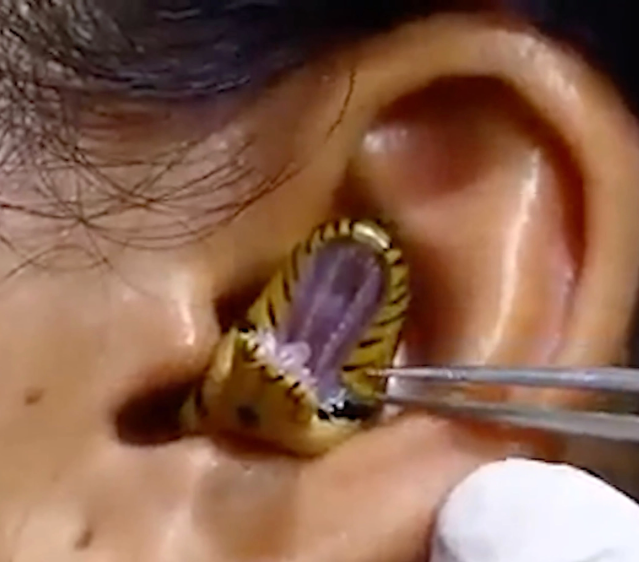 SURGEONS STRUGGLE TO REMOVE LIVE SNAKE FROM WOMAN’S EAR