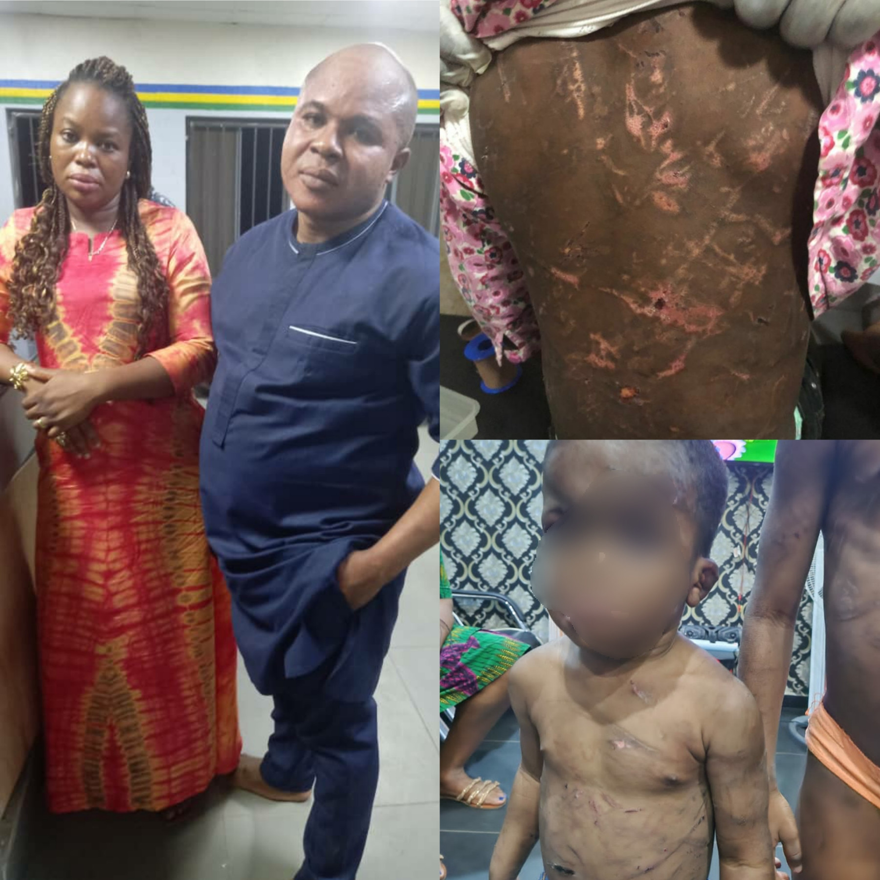 WOMAN AND HER PARTNER ARRESTED FOR ALLEGEDLY BATTERING HER TWO CHILDREN AGED 5 AND 2….SEE HORRIFIC PHOTOS OF THEIR BATTERED BODIES
