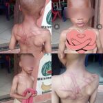 HEARTBREAKING PHOTOS OF 5-YEAR-OLD BOY WITH CANE MARKS ALL OVER HIS BODY AFTER HE WAS ALLEGEDLY ASSAULTED BY HIS AUNT AND HER BOYFRIEND IN PORT HARCOURT