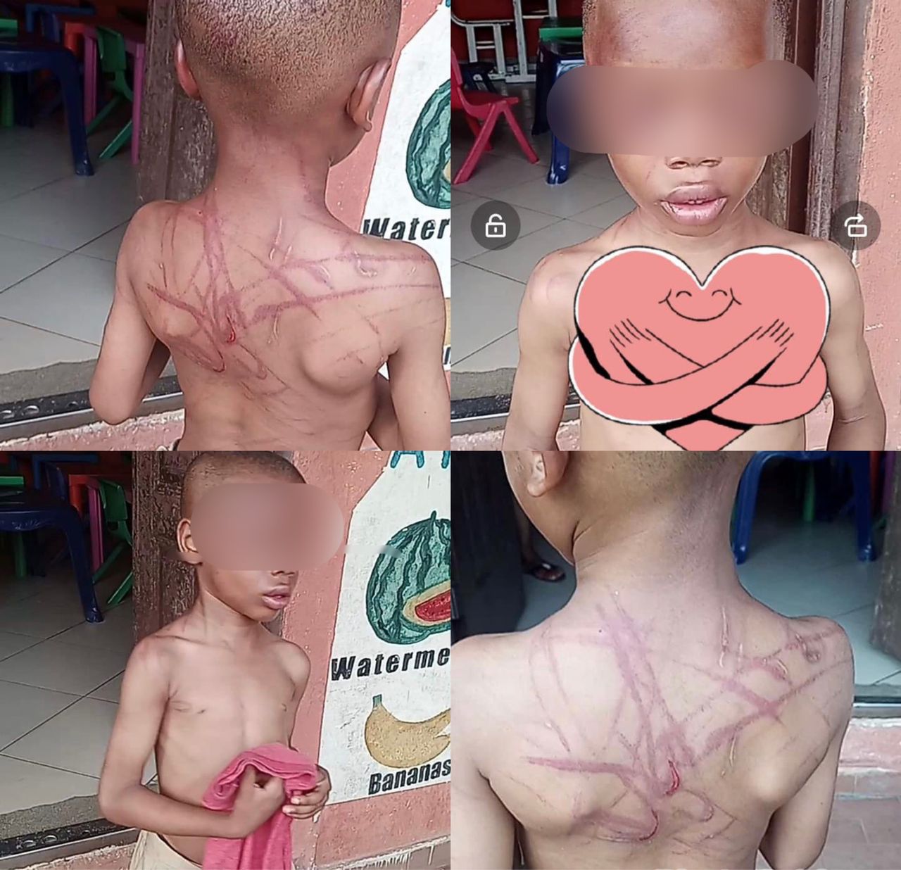 HEARTBREAKING PHOTOS OF 5-YEAR-OLD BOY WITH CANE MARKS ALL OVER HIS BODY AFTER HE WAS ALLEGEDLY ASSAULTED BY HIS AUNT AND HER BOYFRIEND IN PORT HARCOURT