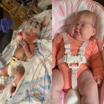 Doctors surprised that “Miracle” Baby born without eyes and had half her brain removed is ‘living and growing well’ (photos)