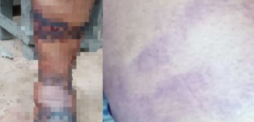 Nursing mother disfugured after she was allegedly brutalised by Special Anti Touting squad in Anambra