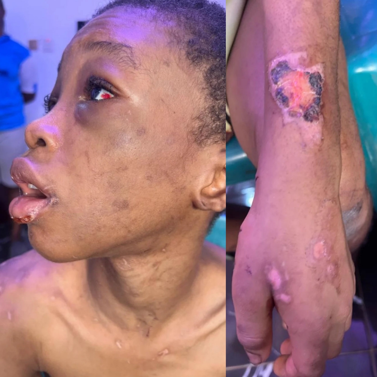 Girl badly b3@ten, burnt and starved by her guardian is rescued in Lagos (photos)